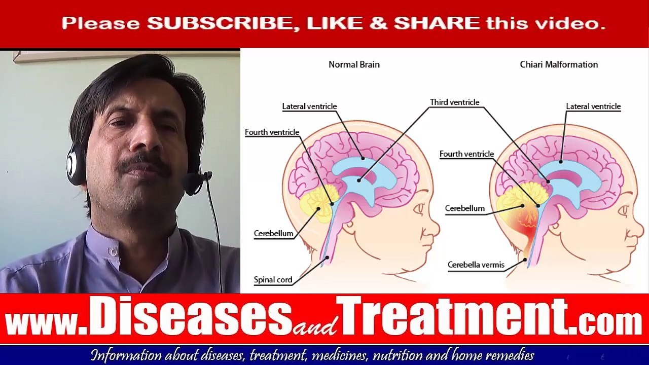 Chiari malformation-  Arnold-Chiari malformation : Causes, Symptoms, Diagnosis, Treatment, Prevention