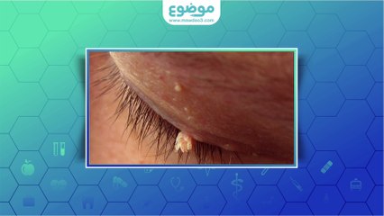 #موضوع: ما هي #الثآليل وأسبابها؟