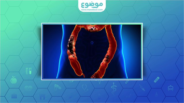 #موضوع: ما هو التهاب القولون التقرحي؟