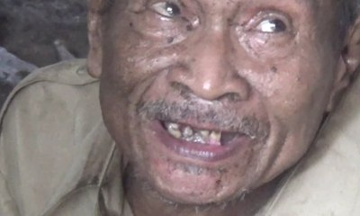 Derita Mardiyo karena Tulang Ekor Patah Sejak Bayi