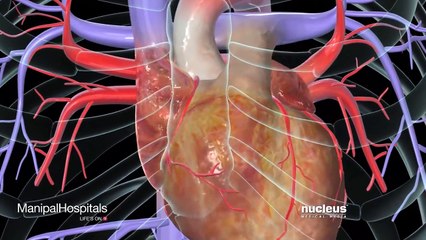 How Coronary artery bypass surgery works – Manipal Hospital