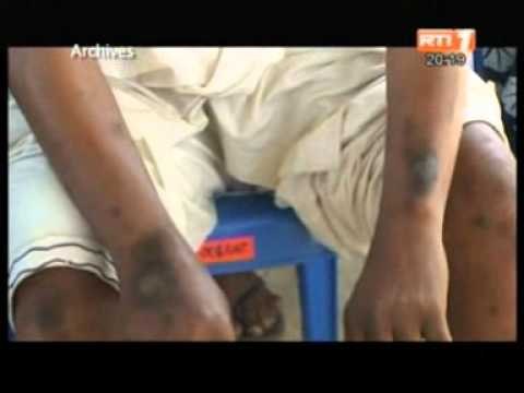 Reportage sur les victimes des dechets toxiques, 5 ans plus tard