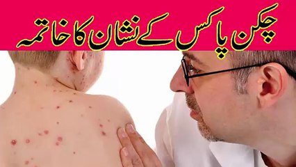 Best tip for chicken pox treatment