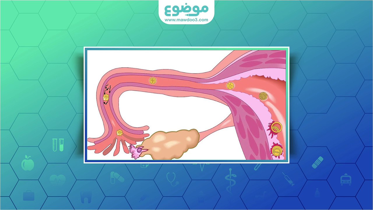 #موضوع: علاج الأكياس على المبايض