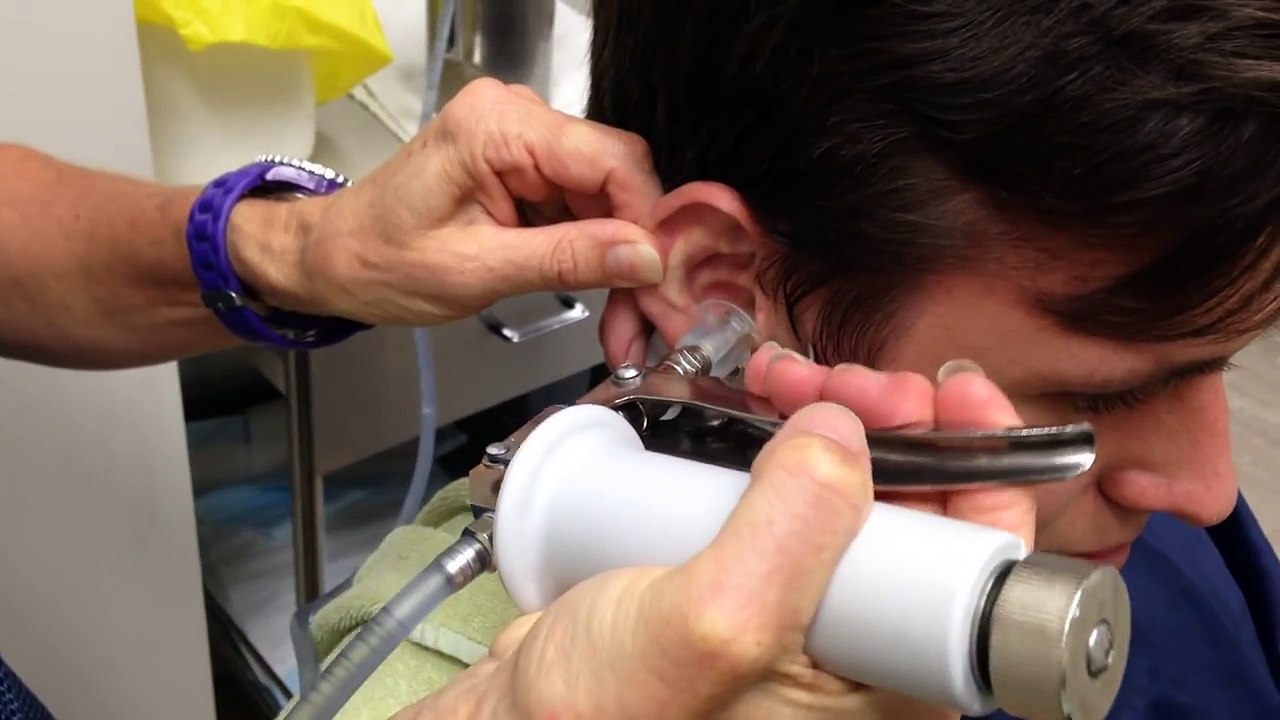 Ear Wax Irrigation DISGUSTING