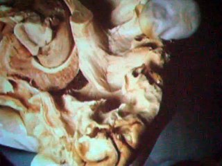 Neuroanatomia Repaso, Diseccion del Fornix a través de Método Klingler