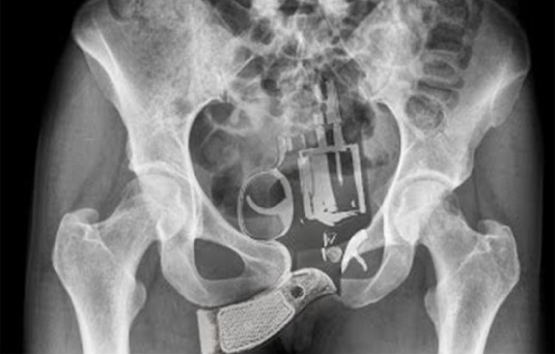 10 Craziest Objects Ever Found Inside People