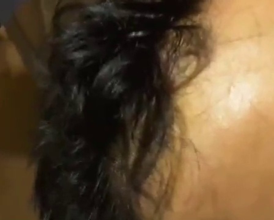 PRP-Therapie-Plättchen-reiche Plasmatherapie in der Haar-Wiederherstellung