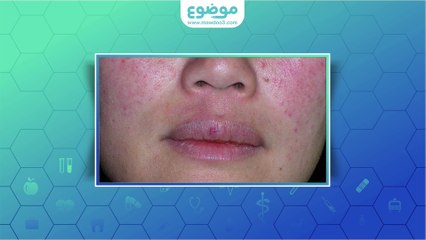 #موضوع: ما هو #مرض #الوردية؟