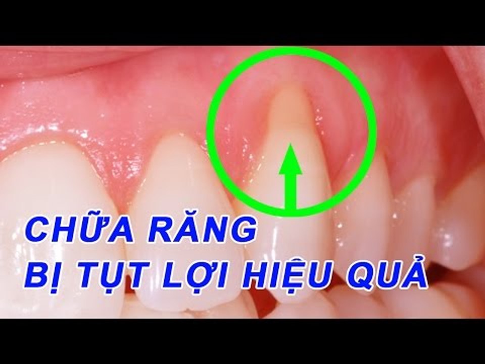 Mẹo Vặt Cuộc Sống - Cách chữa răng bị tụt lợi hiệu quả