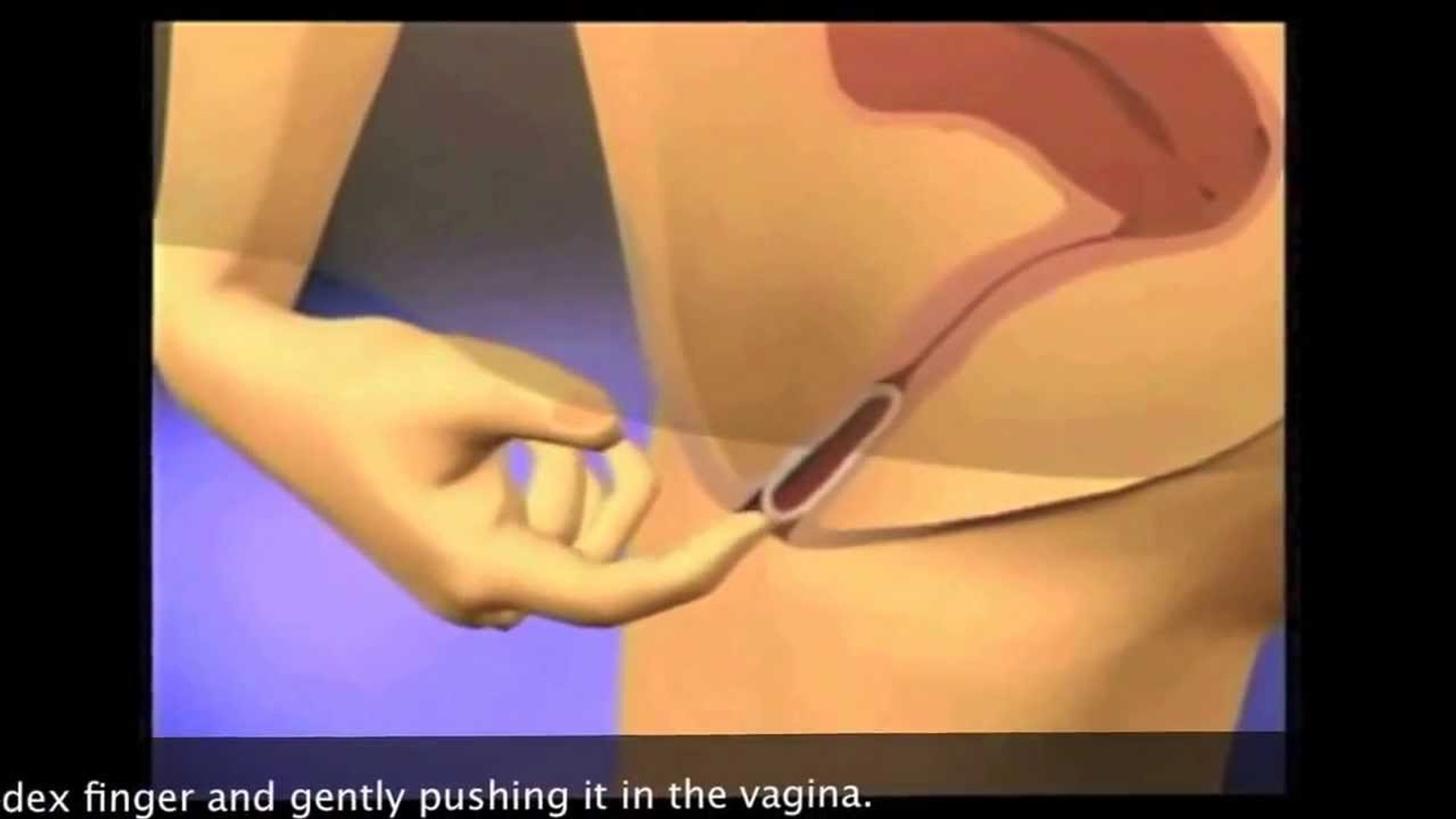 ⁣How to Use NuvaRing - How To Insert Nuvaring