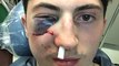 Zach Werenski Takes a Puck TO THE FACE, Out for Playoffs with Facial Fracture