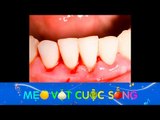 Tuyệt chiêu trị chảy máu chân răng, nướu răng cực hiệu quả - Mẹo Vặt Cuộc Sống