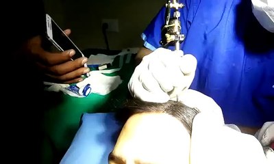 Hair Transplant in Canada