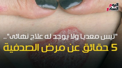 فيديو معلوماتى..ليس معديًا ولا يوجد له علاج نهائى..5حقائق عن مرض الصدفية