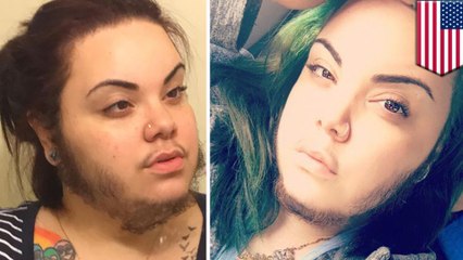 Bearded lady embraces facial hair from hormonal condition