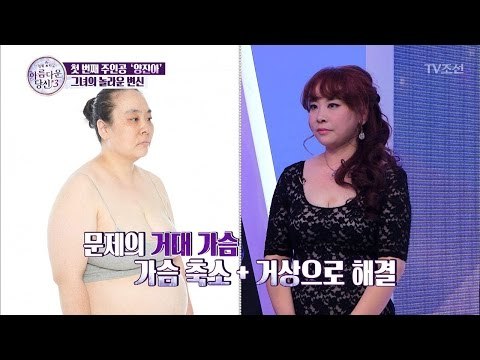 성형 대성공! 어떤 시술들을 했을까? [아름다운 당신 시즌3] 1회 20170318