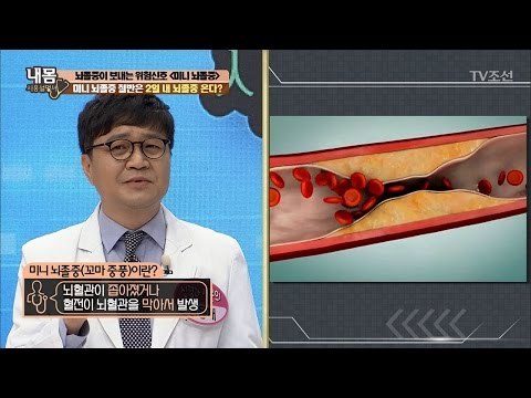 뇌졸중의 경고 신호, ‘미니 뇌졸중’ [내 몸 사용설명서] 146회 20170317
