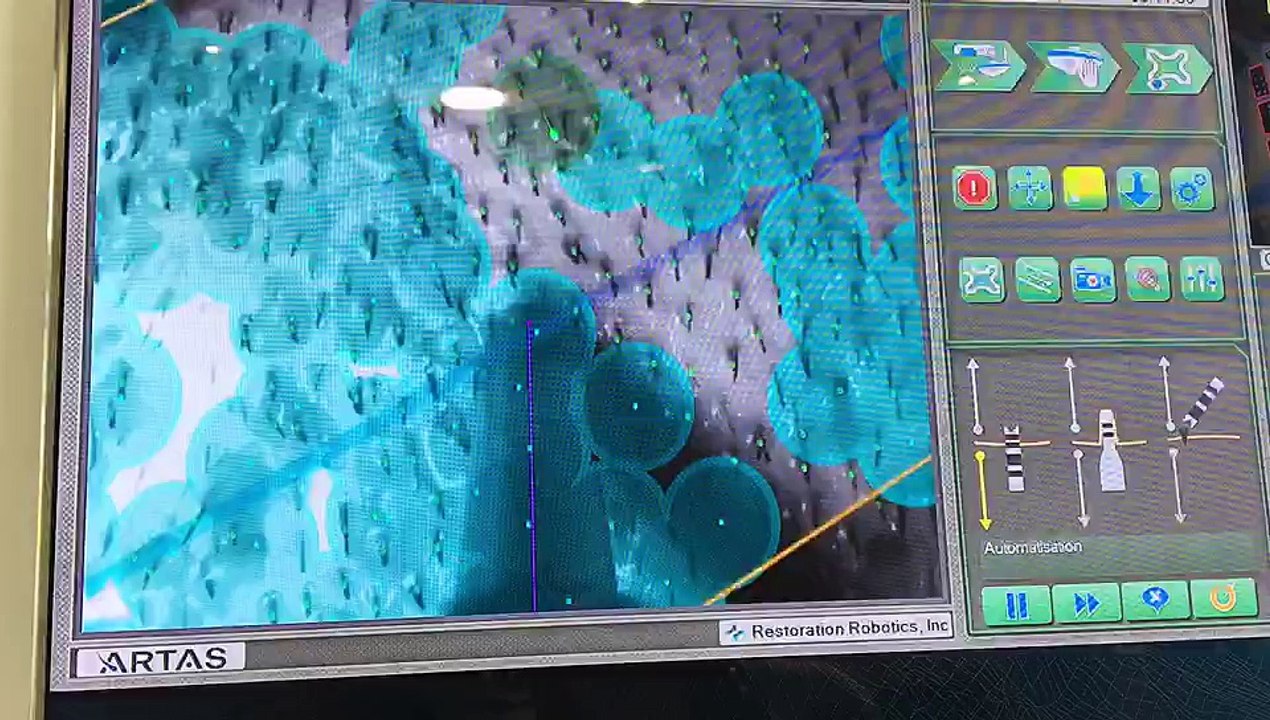 Suivi de l'aiguille de prelevement_selection des greffons