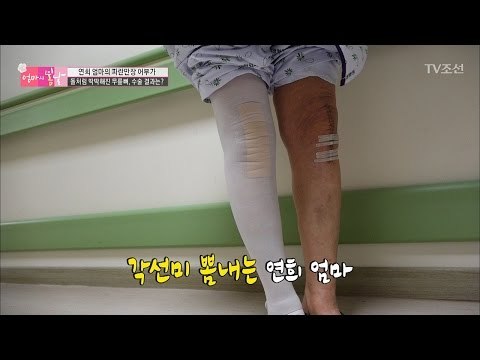 수술을 마친 엄마! 무릎 건강은 물론 각선미까지 되찾았다? [엄마의 봄날] 79회 20170305