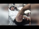 iPhone exploded in man's pocket giving him horrific burns, See pic | Oneindia News