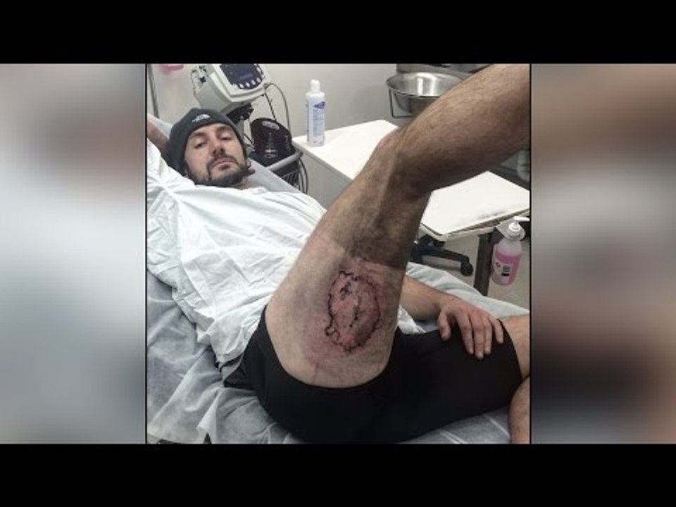 iPhone exploded in man's pocket giving him horrific burns, See pic | Oneindia News