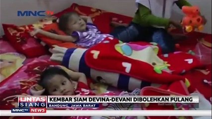 Jalani Operasi Pemisahan, Balita Kembar Siam Boleh Pulang