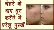 Skin Scars removal remedies | चेहरे के दाग दूर करेंगे ये घरेलू नुस्खें | BoldSky