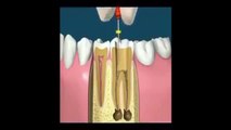 Root Canal Treatment, Latest Tooth Saving Technology, Amazing