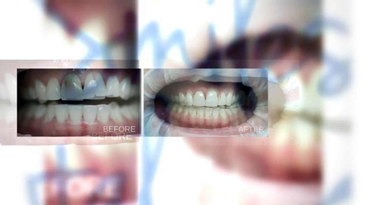 Brookhaven Crowns - Call 770-455-6602