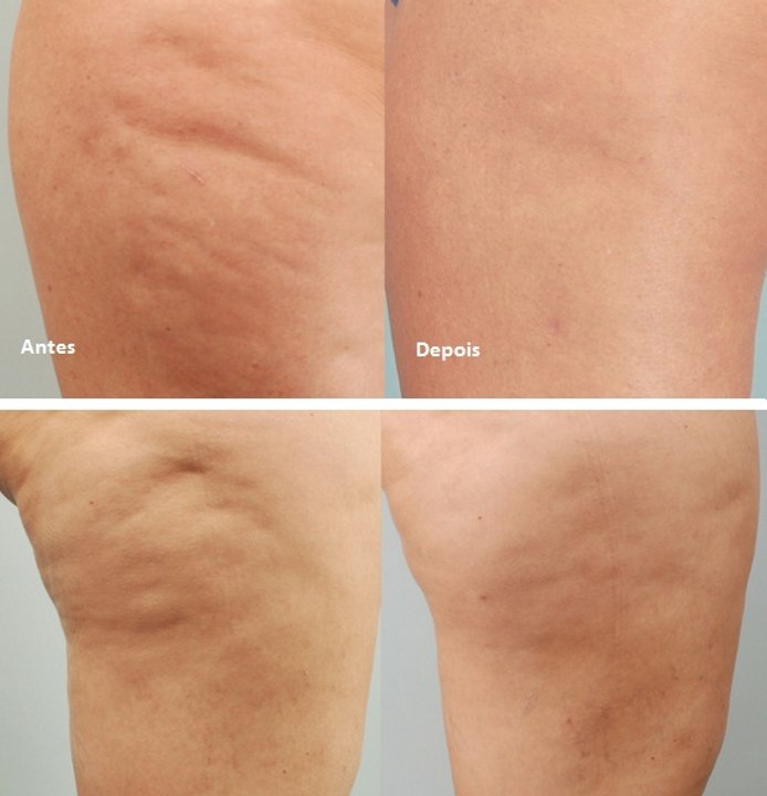 Como acabar com CELULITE das coxas e gluteos em poucos dias Por Nina Della Rosa