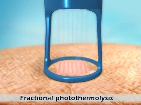 PIXEL – Laser Resurfacing for Texture, Wrinkles & Pores