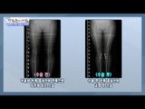 퇴행성 관절염 치료법 ‘근위경골절골술’은? [광화문의 아침] 401회 20170113