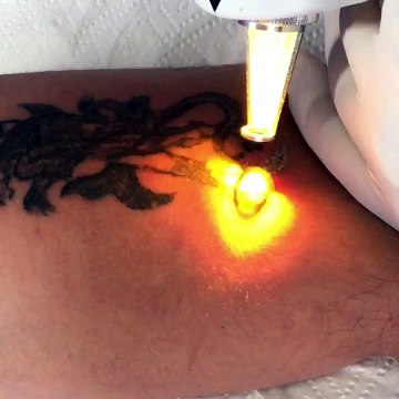 #Kalıcı #Dövme #silimi #duzce #hendek #karasu #adapazarı #izmit #tattooremove #tattooartist #ndyag #qmagich #laser #sakarya