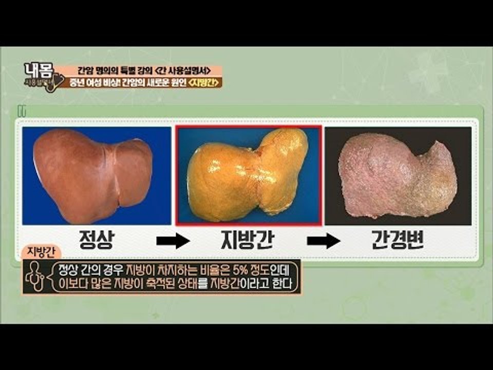중년 여성 비상! 간암의 새로운 원인 ‘지방간’ [내 몸 사용설명서] 136회 201...
