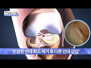무리한 겨울운동! 무릎 주의보 [광화문의 아침] 391회 20161230