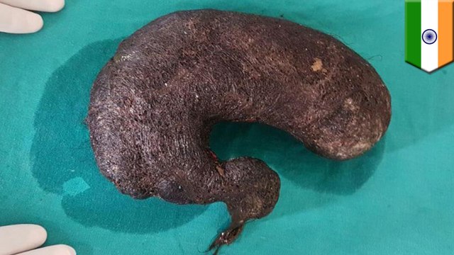 Doctors cut melon-sized hairball out of teenager’s stomach