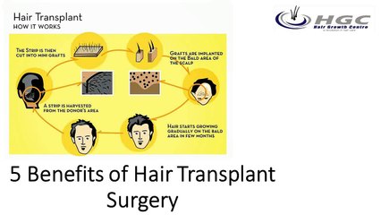 5 Benefits of Hair Transplant