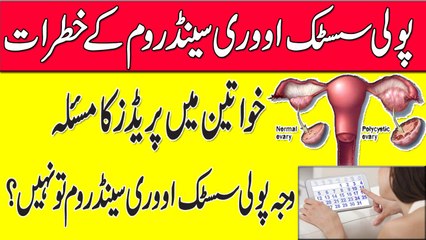 Irregular Menstrual Cycle Problem || PolyCystic Ovary Syndrome In Urdu