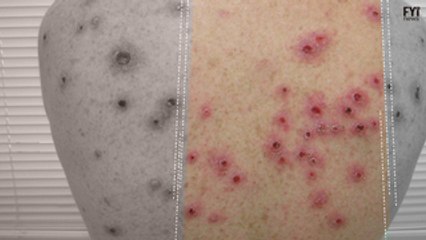 Sífilis no Brasil supera Zika em casos