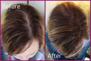 Regrows Lost Hair After 19 Days Baldness Cure Branded Too Simple To Ever Work
