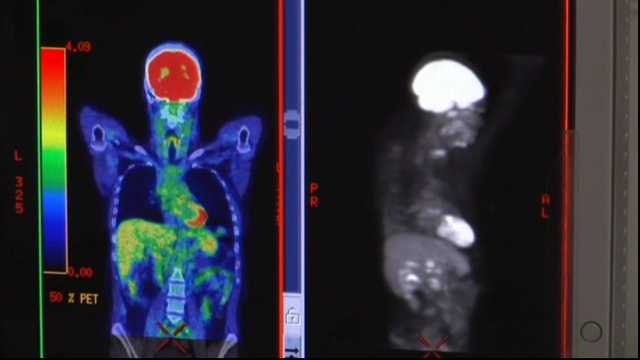 Lutte pour tuer Le Cancer Grâce Aux Virus