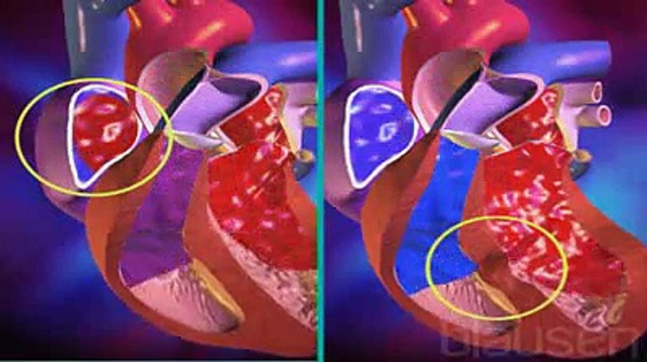 Cardiopathie congénitale