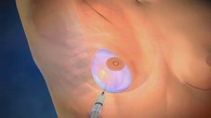 Augmentation mammaire