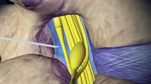 Injections spinales