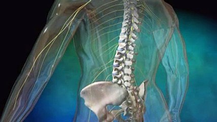 Arthroplastie discale avec prothèse