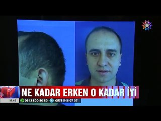 Kepçe kulaklar ve bozulan kulak memeleri estetik ameliyatla böyle düzeltiliyor