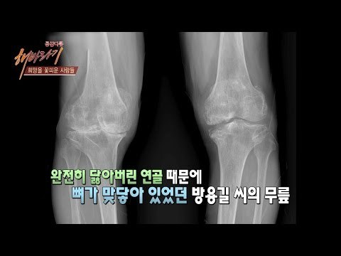 무릎관절 환자였던 방용길씨를 만나다! [해바라기] 16회 20160813