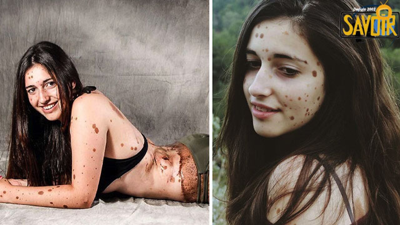 Cette adolescente a été brutalement touché pour avoir plus de 500 points des taches de naissance, mais regardez-la maintenant!!