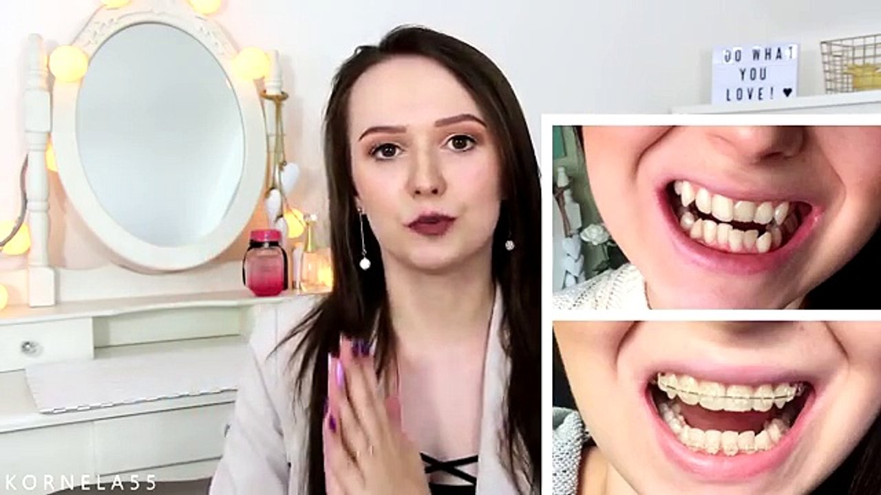 KORNELA APARATKA #5 ❤️ ŚCIĄGNIĘCIE, ZDJĘCIA PRZED I PO, APARATY RETENCYJNE